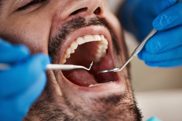 Best Emergency Treatment for Dental Infections or Abscesses in Guernsey, WY