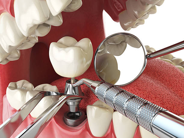 Best Emergency Tooth Extraction in Guernsey, WY